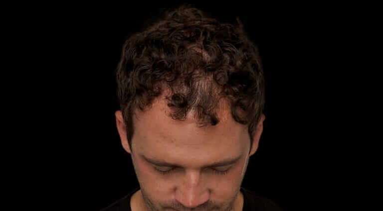 How to Fight Thinning Hair