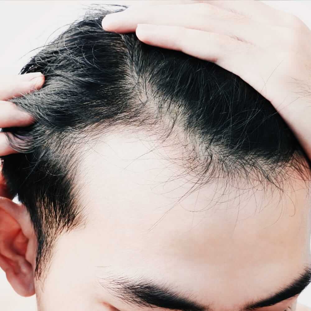 The Fix for Thinning Hair Starts Here