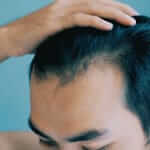 The Fix for Thinning Hair Starts Here