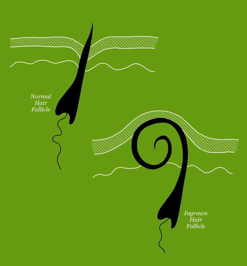 Illustration of how an ingrown hair forms