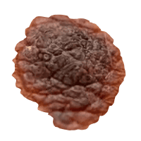 Melanoma illustration