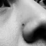 Get Rid of Blackheads (Without Wrecking Your Skin)