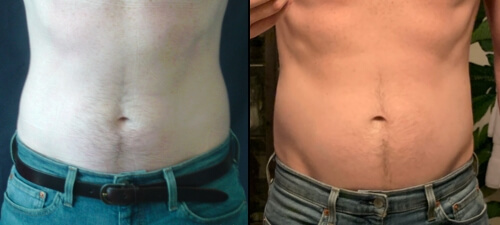 Valet.'s editor Cory Ohlendorf before and after WarmSculpting procedure