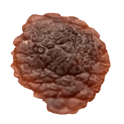 Melanoma spot example