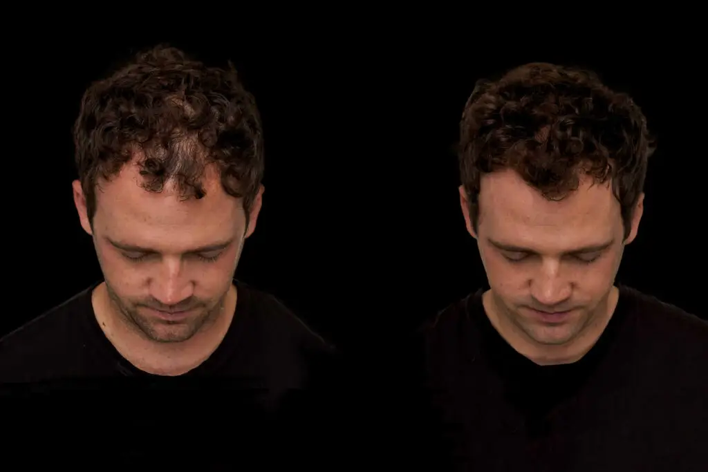 Best hair loss treatments for men