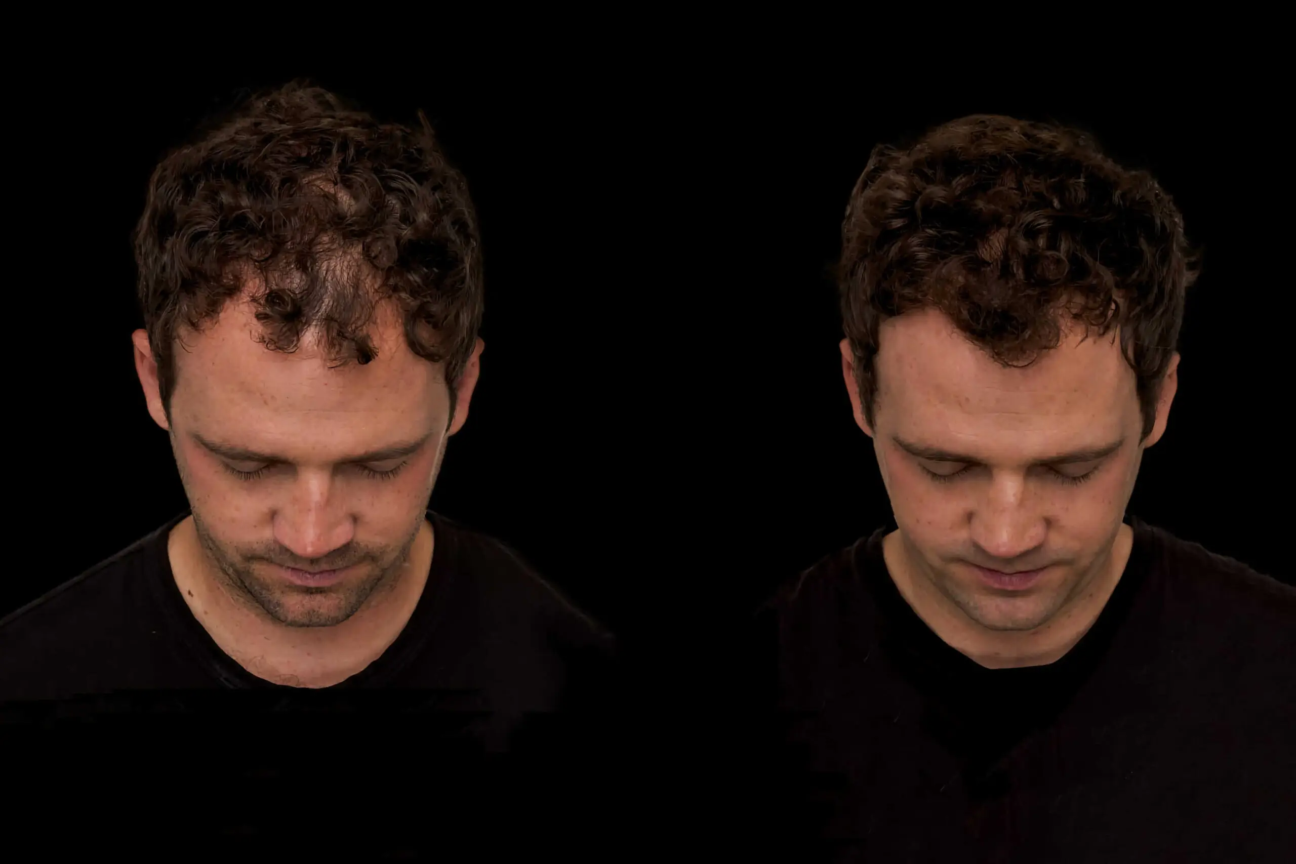 Best hair loss treatments for men