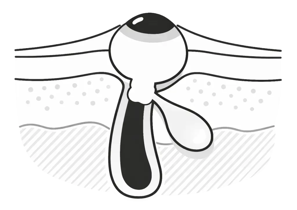 Blackhead comedone illustration