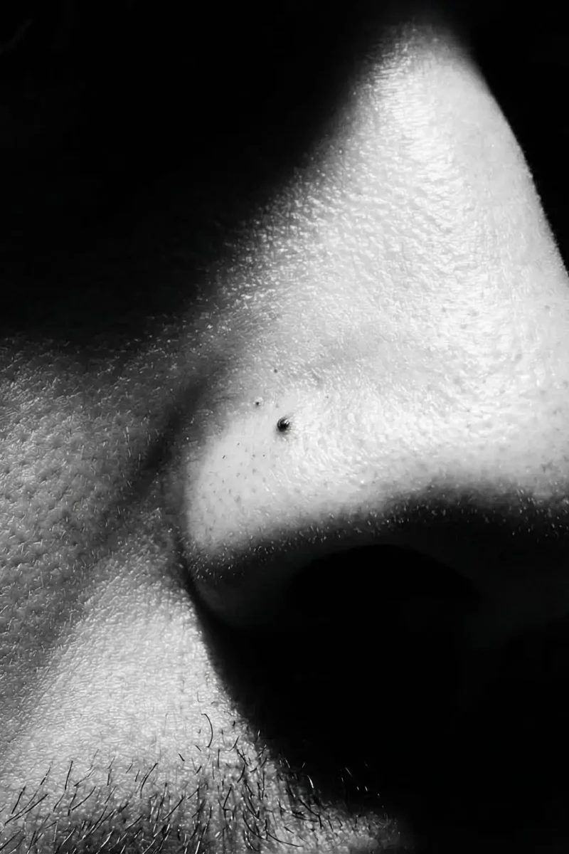 How to remove blackheads